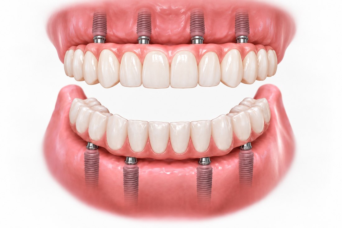 Fixed full-arch bridges secured onto four implants in both the upper and lower jaws