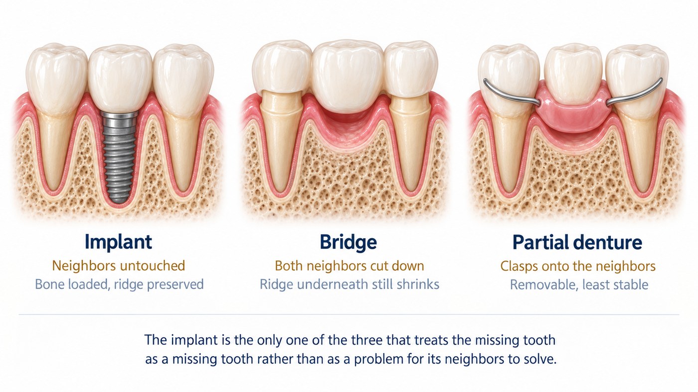Implant, bridge and partial denture compared side by side