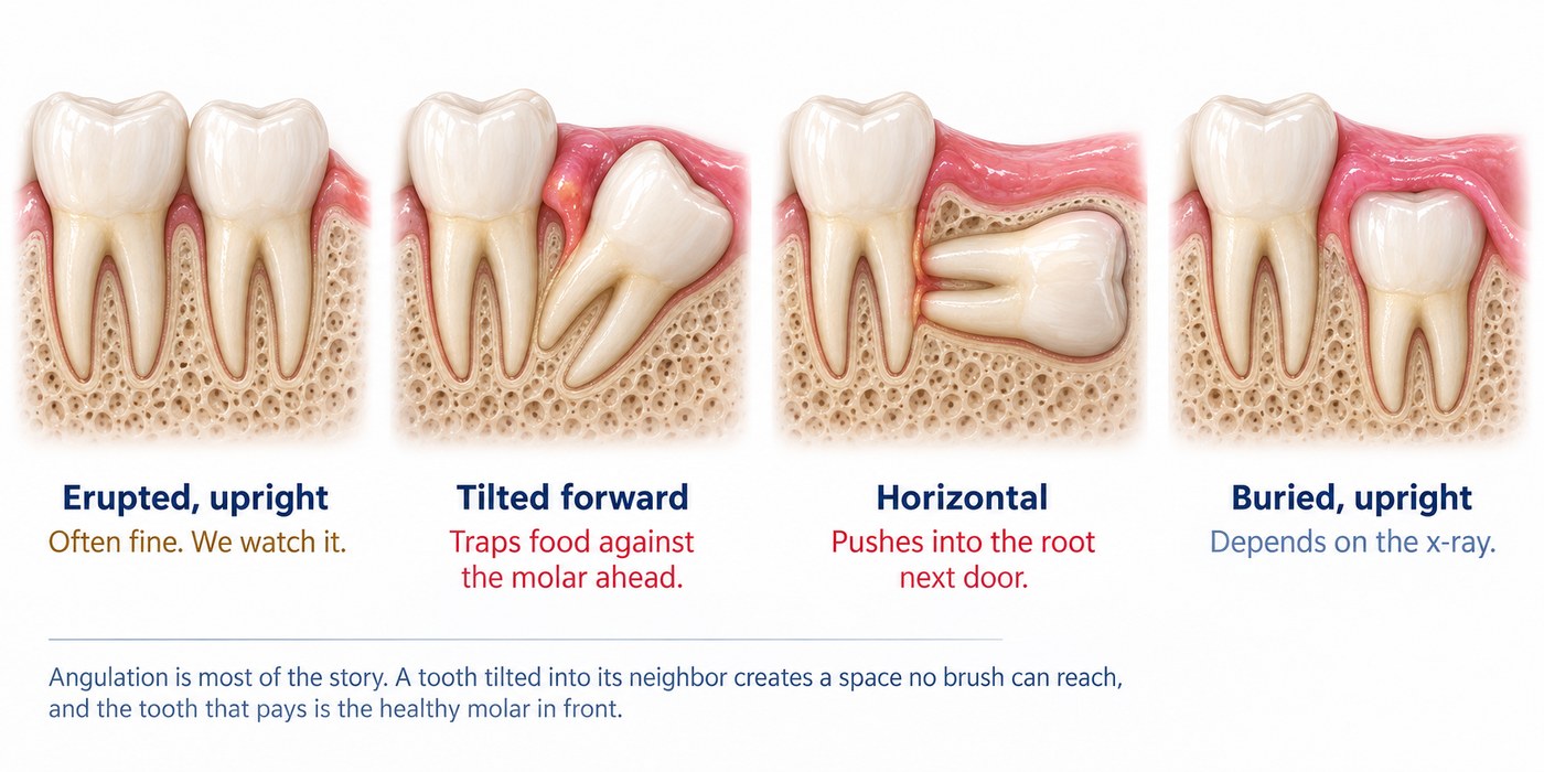Four wisdom tooth positions: erupted and upright, tilted forward, horizontal, and buried upright